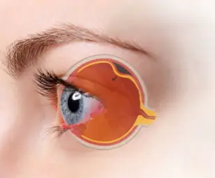 Razones que provocan el desprendimiento de retina