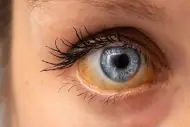 Ojos amarillos: posibles causas y cómo tratar