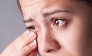 Síntomas y Tratamiento: Conjuntivitis