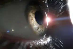 Tratamiento Cirugia Lasik